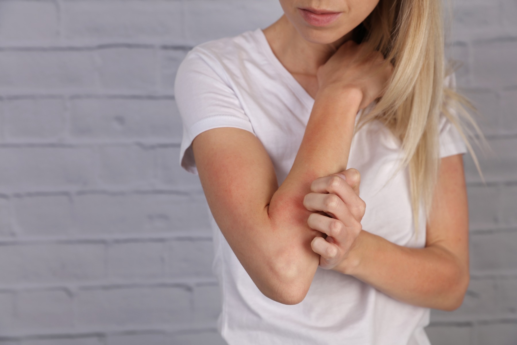 How to treat eczema