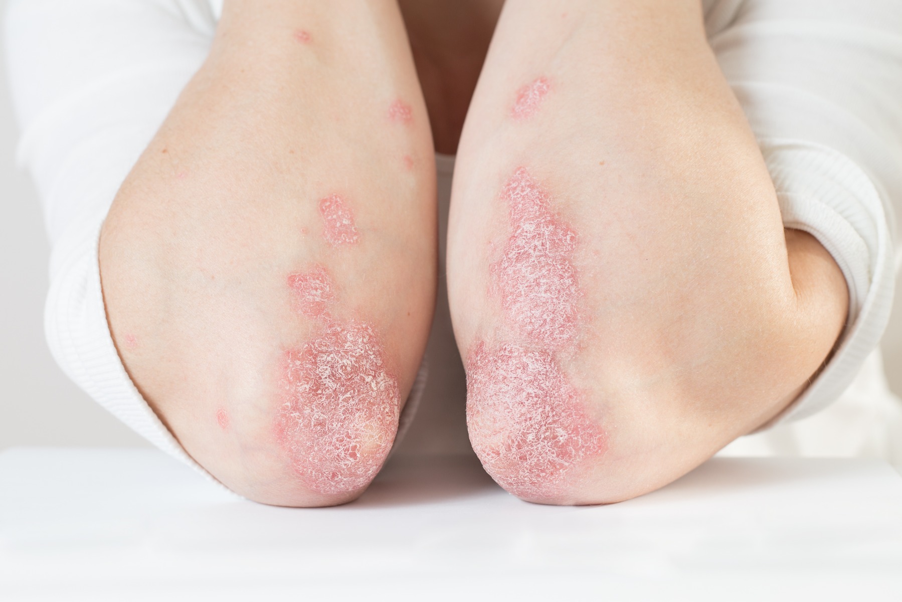 psoriasis