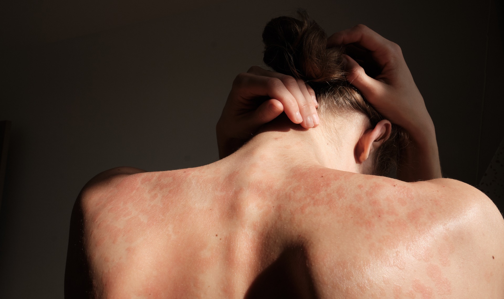 What causes psoriasis?